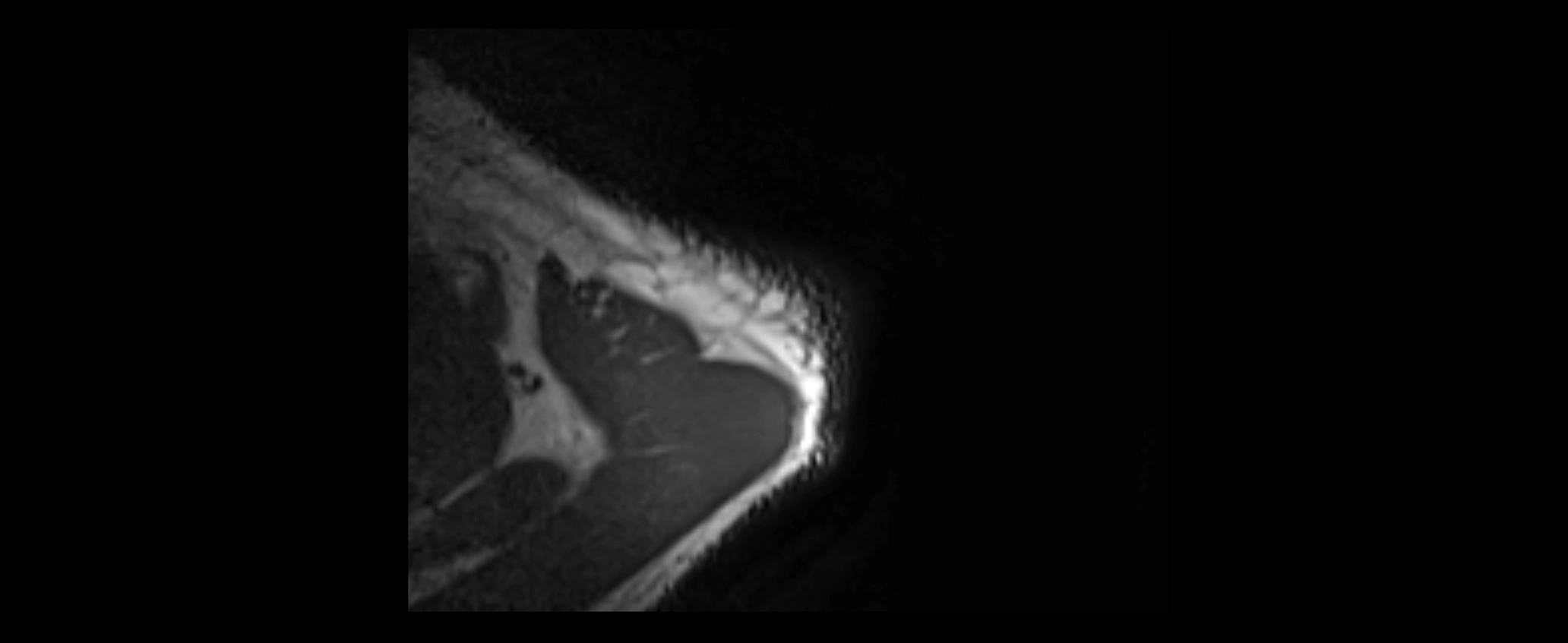 shoulder ligaments axial 3d 3t mri image-img-00005-00007.webp